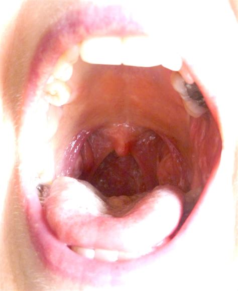 Help Please Is This A Swollen Salivary Duct Salivary Gland