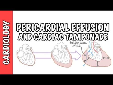 PERICARDIAL EFFUSION Vs CARDIAC TAMPONADE EXPLAINED IN 5 MINUTES