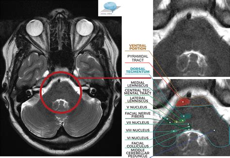 Midbrain Pons And Medulla Anatomy And Syndromes Radiographics