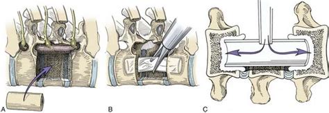 Thoracoscopic Approaches To The Spine Neupsy Key