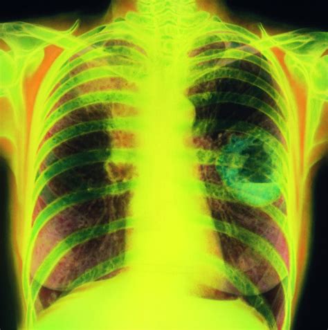 Chest X Ray Lung Cancer Stage