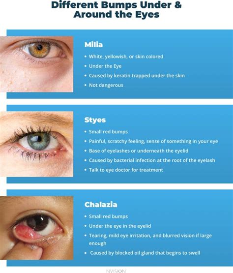 Bumps Under The Eyes Types And How To Treat Them Nvision Eye Centers