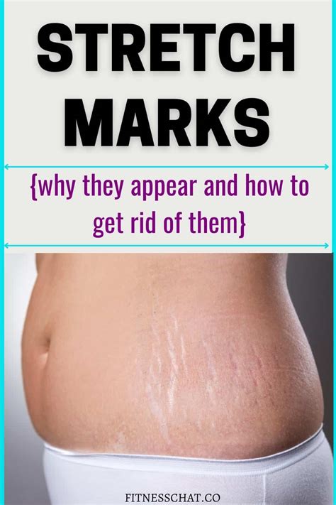 How To Remove Stretch Marks Fast 5 Easy Remedies That Actually Work
