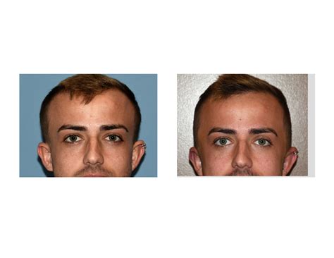 Plastic Surgery Case Study Head Width Narrowing By Temporal Reduction