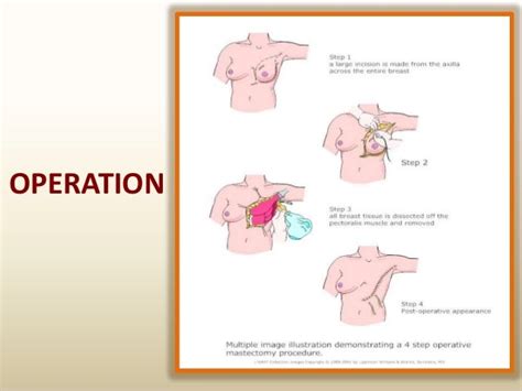 mastectomy and breast cancer