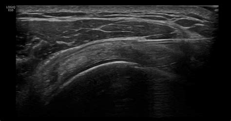 Ultrasound Guided Shoulder Injections The Ultrasound Site Ultrasound Guided Shoulder Joint