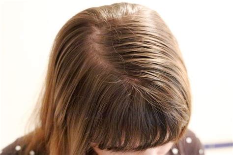 What Are The Causes Of Oily Hair After One Day Oily Hair Thin Greasy