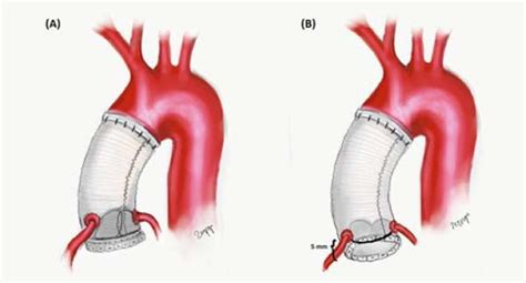 Braz J Cardiovasc Surg Influence Of Bentall Procedure On Left