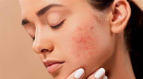 Dermatologist Explains The Major Causes Of Adult Acne Life Style News