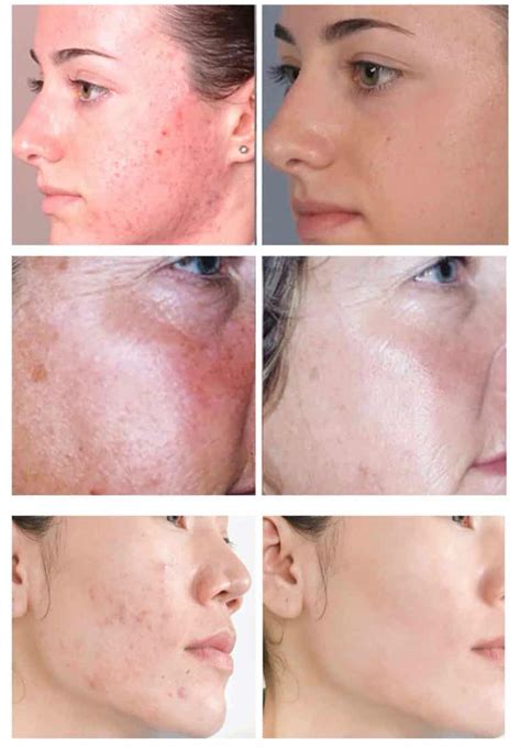 Silkpeel Dermal Infusion Arion Skin Laser Clinic Vancouver