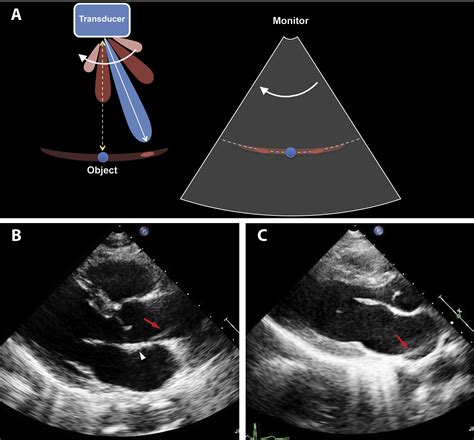 Fact Or Artifact In Two Dimensional Echocardiography Avoiding