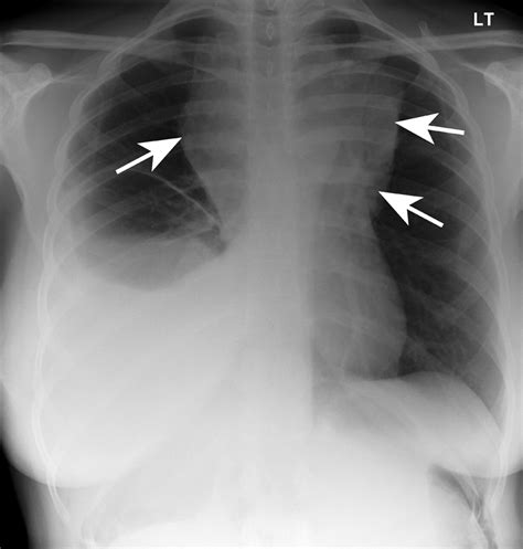 chest x ray in first trimester of pregnancy pregnancywalls