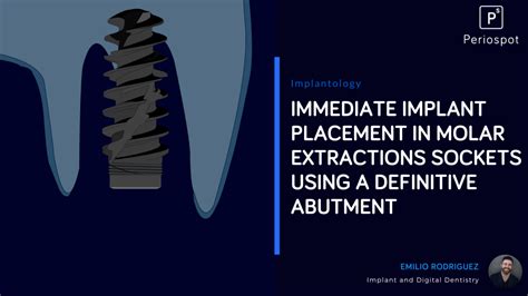Immediate Implant Placement In Molar Extractions Sockets Using A