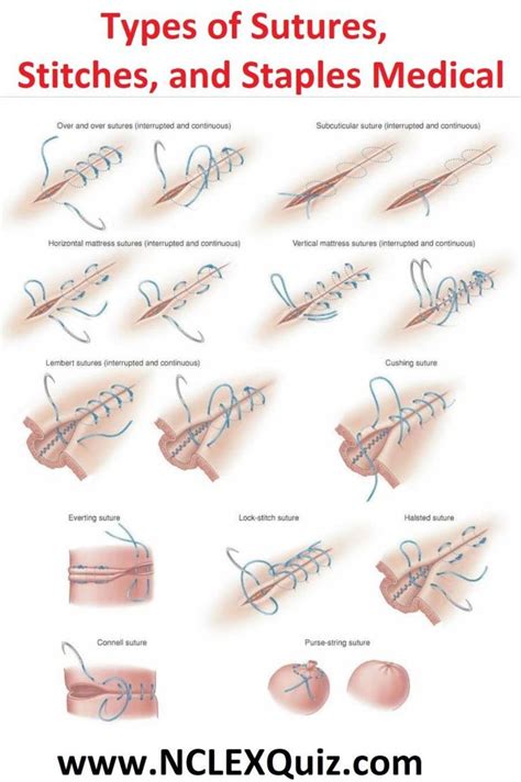 Types Of Sutures Stitches And Staples Medical Medicalstudents Types