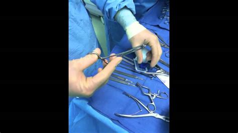 Toe Shortening Surgery With Smart Toe Implant Dr Robert J Moore Iii