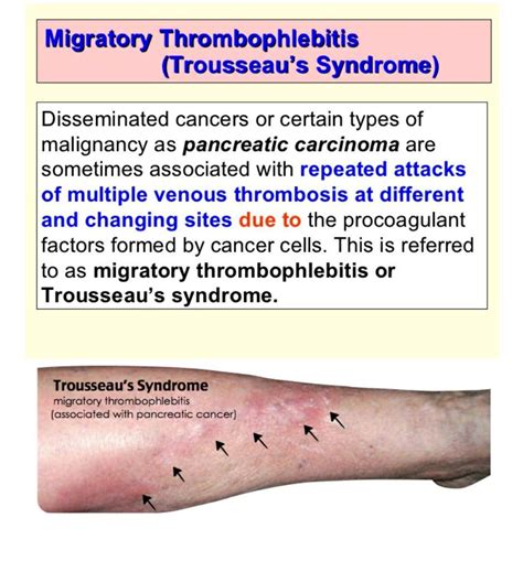 Symptoms Of Trousseau Syndrome Medizzy