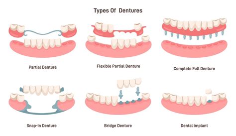 All About Dentures A Comprehensive Guide