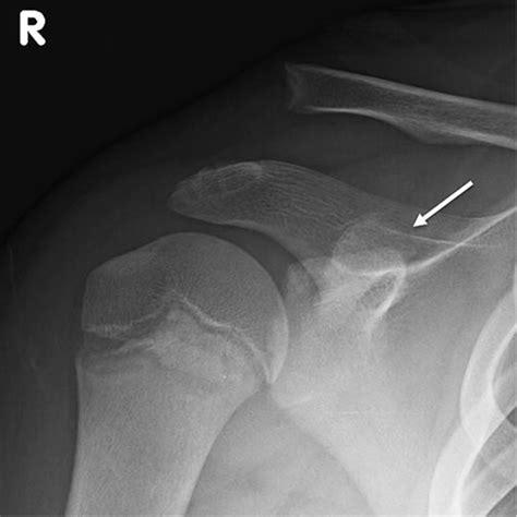 Acromioclavicular ‘pseudo Dislocation With Concomitant Coracoid