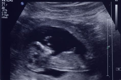 Whirligig Bug 12 Week Ultrasound Photos Pregnancy Update 6