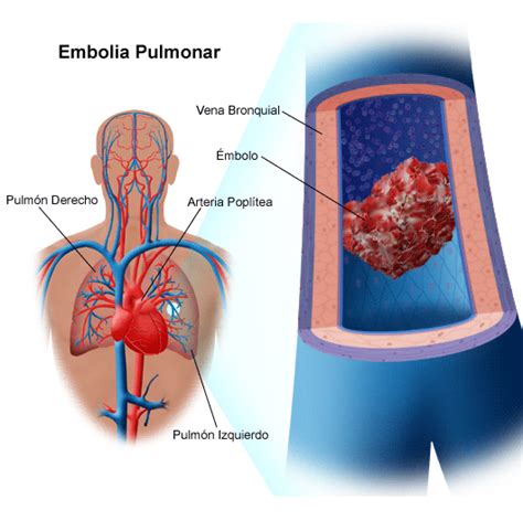 Embolia Pulmonar Sintomas Causas Tratamento E Cirurgia