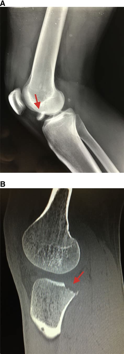 A Radiograph And B And C Ct Scan Images Of The Knee Showing