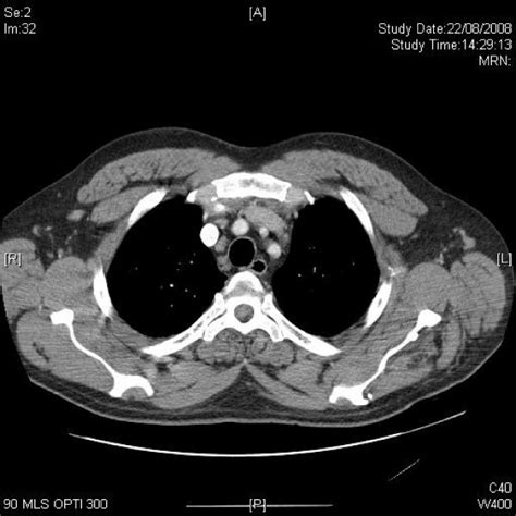 Axial Ct Of Upper Chest Shows Mildly Enlarged Axillary And Mediastinal