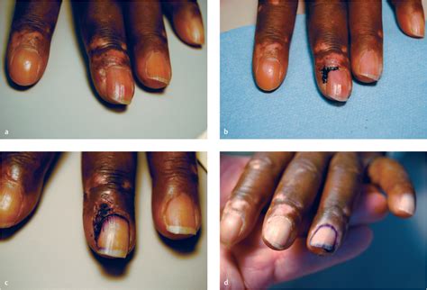 Gentian Violet Treatment Of Severe Chronic Paronychia Musculoskeletal Key