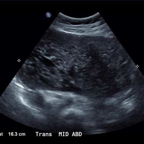 Ultrasound Image Demonstrating A Large Heterogenous Soft Tissue Mass