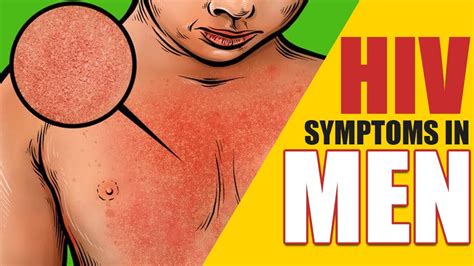 Hiv Aids Symptoms In Men After 1 Week Hiv Symptoms Hiv