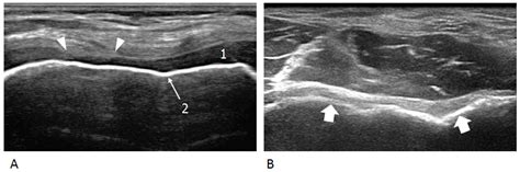 Jcm Free Full Text Ultrasound For Early Detection Of Joint Disease
