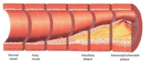 Arterial Ulcer Pathophysiology
