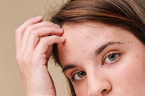 What Causes Scalp Acne And Pimples On The Head And Hairline