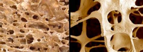 Main Causes of Osteoporosis in Men and Women | IYTmed.com