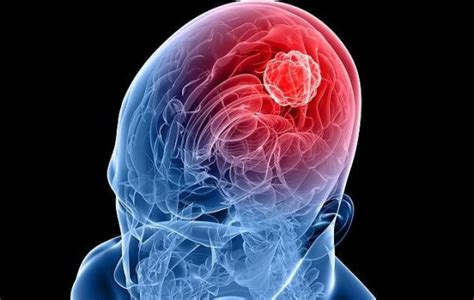 The Patients Outlook With Stage 4 Brain Cancer Survival Rates