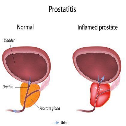 Men with prostate cancer should not perform prostate massage without consulting a doctor or oncologist, due to the risk of releasing prostatic cancer cells that can spread cancer to other parts of. Pin on prostatitis