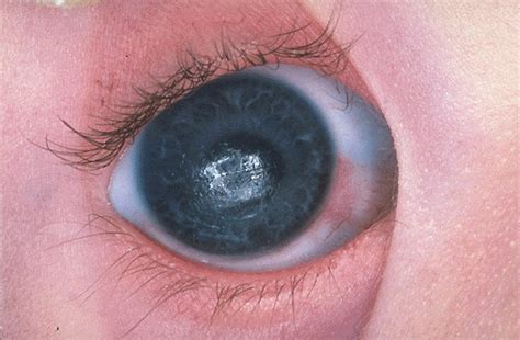 Epicanthal folds are normal in asian races. Down syndrome