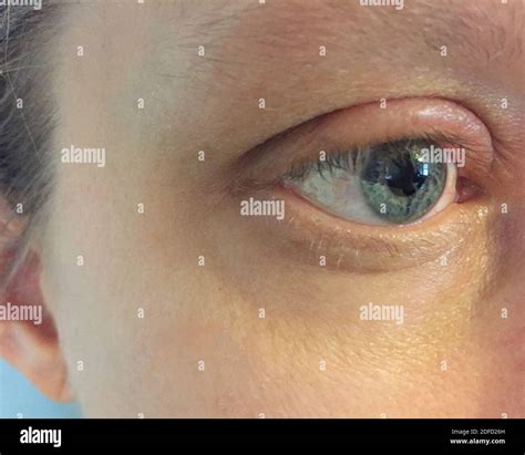 Swollen Eyelid Due To Allergy Stock Photo Alamy