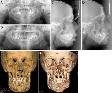 Cherubism Best Clinical Practice Orphanet Journal Of Rare Diseases Full Text