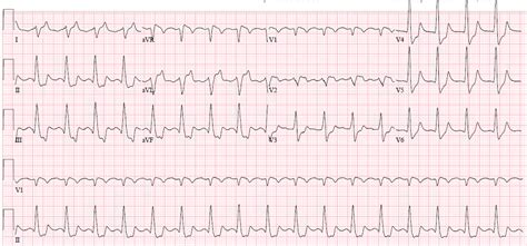 Dr Smiths Ecg Blog St Elevation In Avl With Reciprocal