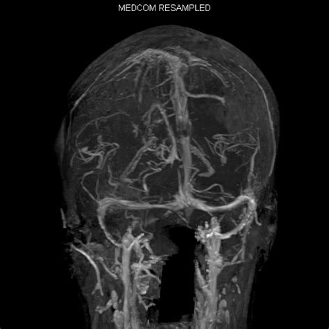 Superior Sagittal Sinus Thrombosis Image