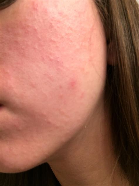 why is my face itchy with little bumps allergy trigger