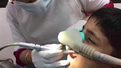 Dental Treatment Under Laughing Gas Anaesthesia Youtube