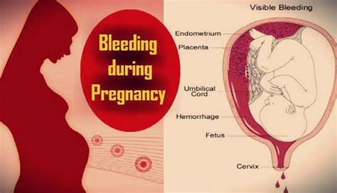Any Kind Of Bleeding During Pregnancy Needs Attention Lifeberrys Com