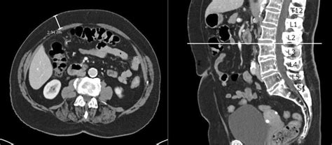 Ct Image Showing The Technique Of Abdominal Subcutaneous Fat