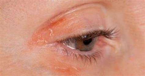 Colloidal silver can be administered orally, in the eyes (for eye allergies, conjunctivitis, keratitis, etc.), in the nose. Colloidal Silver & Eczema | Colloidal gold, Fungal ...