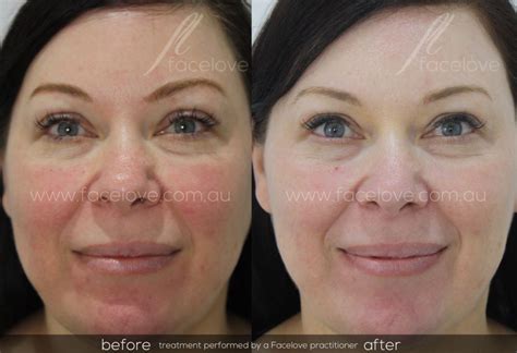 Capillary Facial Redness Reduction Facelove