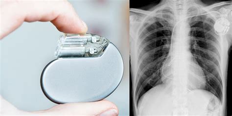 Pacemaker And Implantable Defibrillator Dr Paul Ong