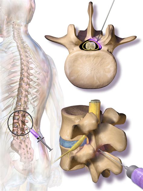 Phys med rehabil clin n am. Epidural Steroid Injection | Bone and Spine