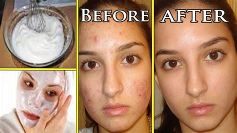 Easy Way To Remove Acne Overnight Health And Fitness Life Care