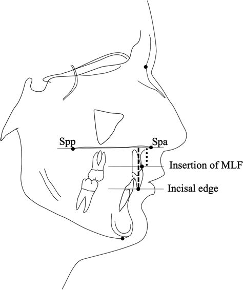 Longitudinal Changes Of The Insertion Of The Maxillary Labial Frenum In
